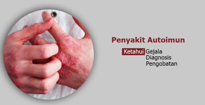 Menghadapi Autoimun: Strategi dan Kiat untuk Menjalani Hidup Sehat