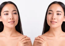 Implan Hidung: Transformasi Estetika yang Membawa Percaya Diri