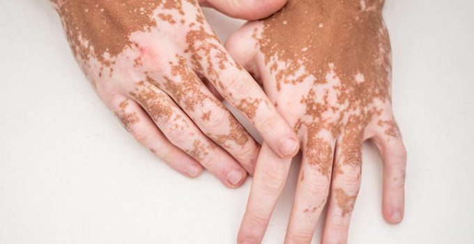 Memahami Penyebab Vitiligo dan Faktor Pemicu Utamanya