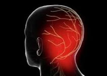 Sakit Kepala Belakang Parah? Kenali Neuralgia Oksipital